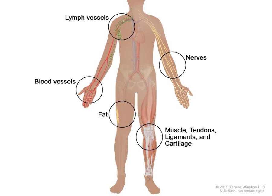 Soft-tissue sarcoma forms in soft tissues of the body, including muscle, tendons, fat, blood vessels, lymph vessels, nerves, and tissue around joints.