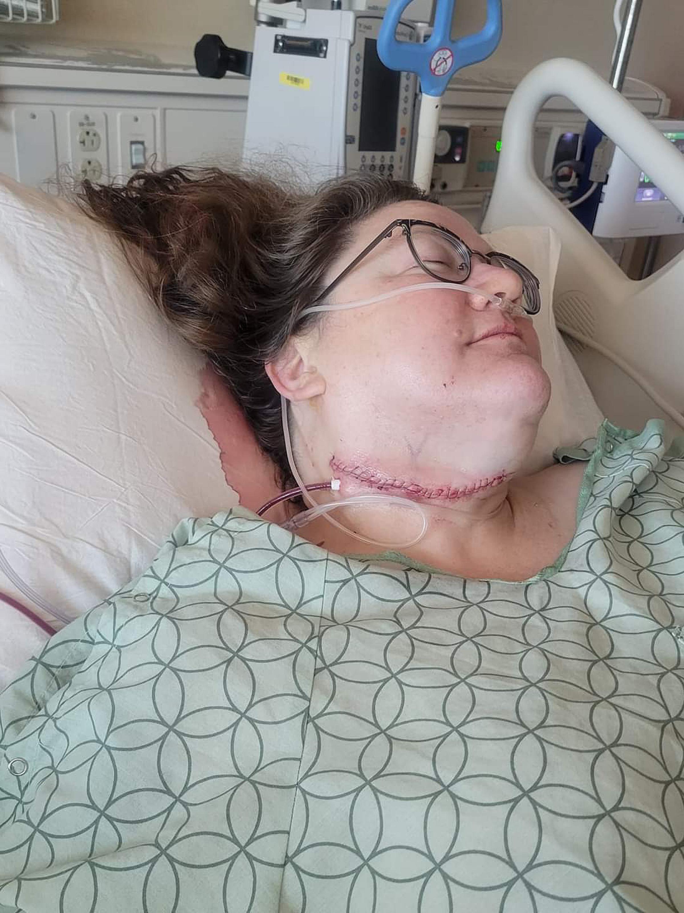 Karen after tongue cancer surgery and neck dissection
