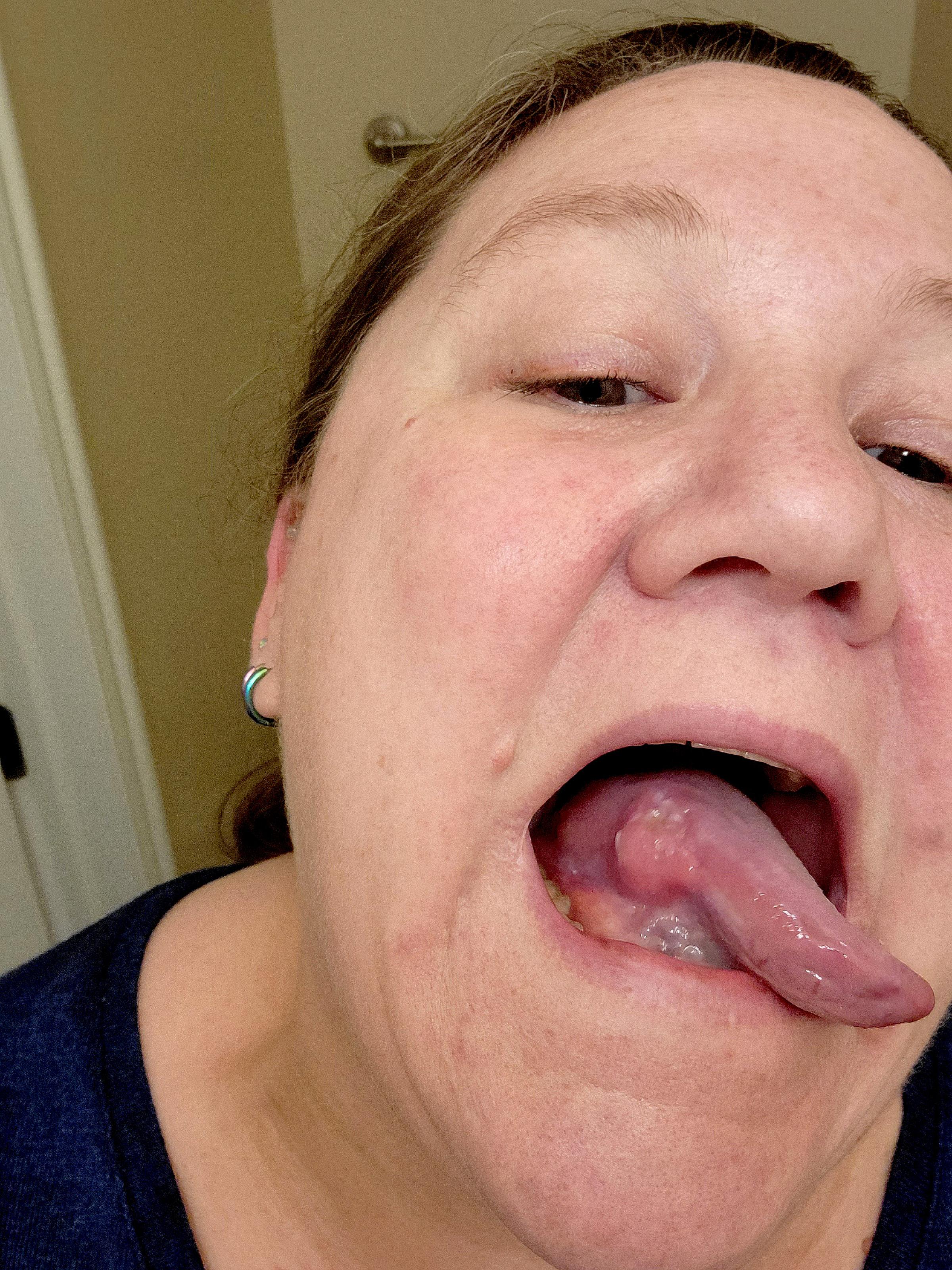 Karen's tongue cancer bump before surgery