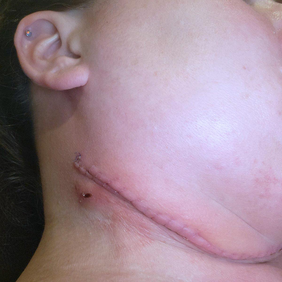 Karen Jensen's neck healing after several days