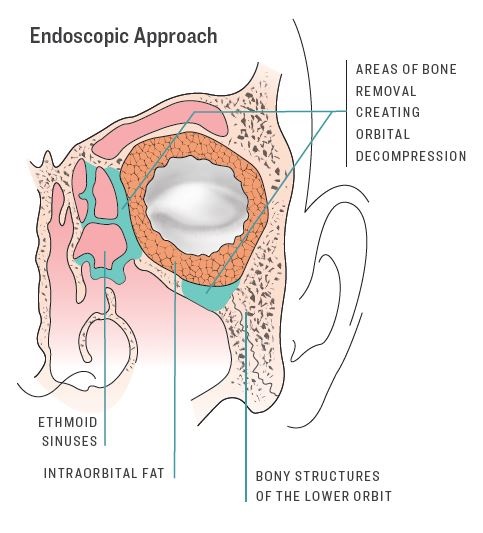 Drawing of human eye with endoscopic approach