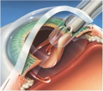 Clear Lens Extraction (CLE) Illustration