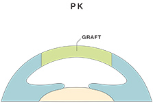 Penetrating Keratoplasty (PK)