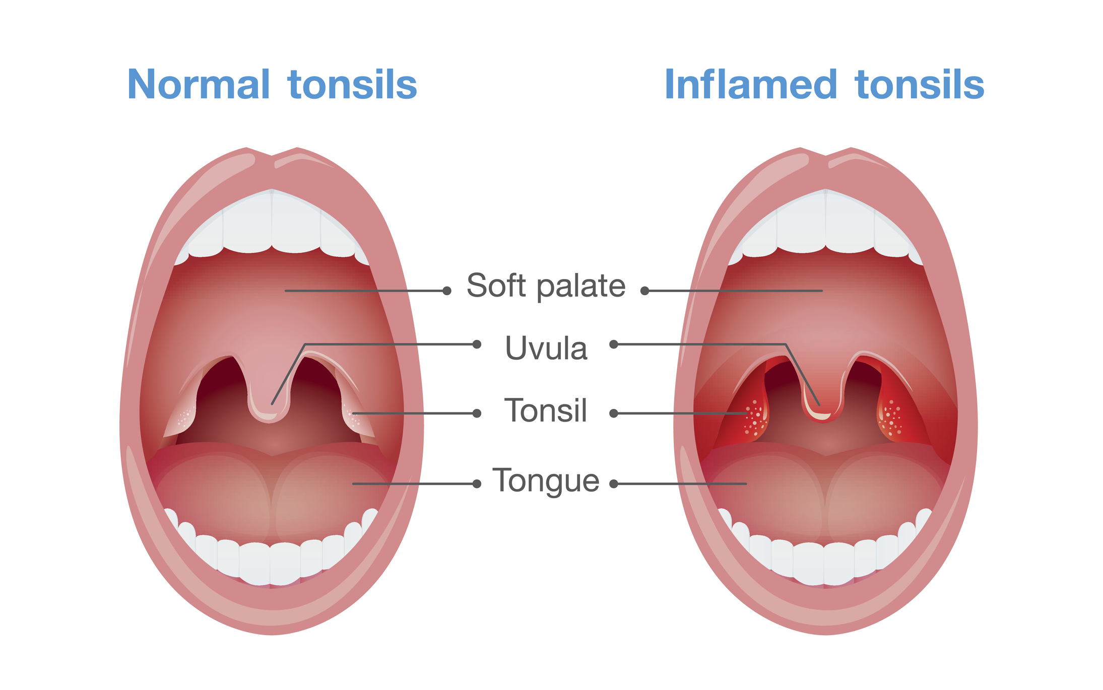 Normal vs inflamed tonsils