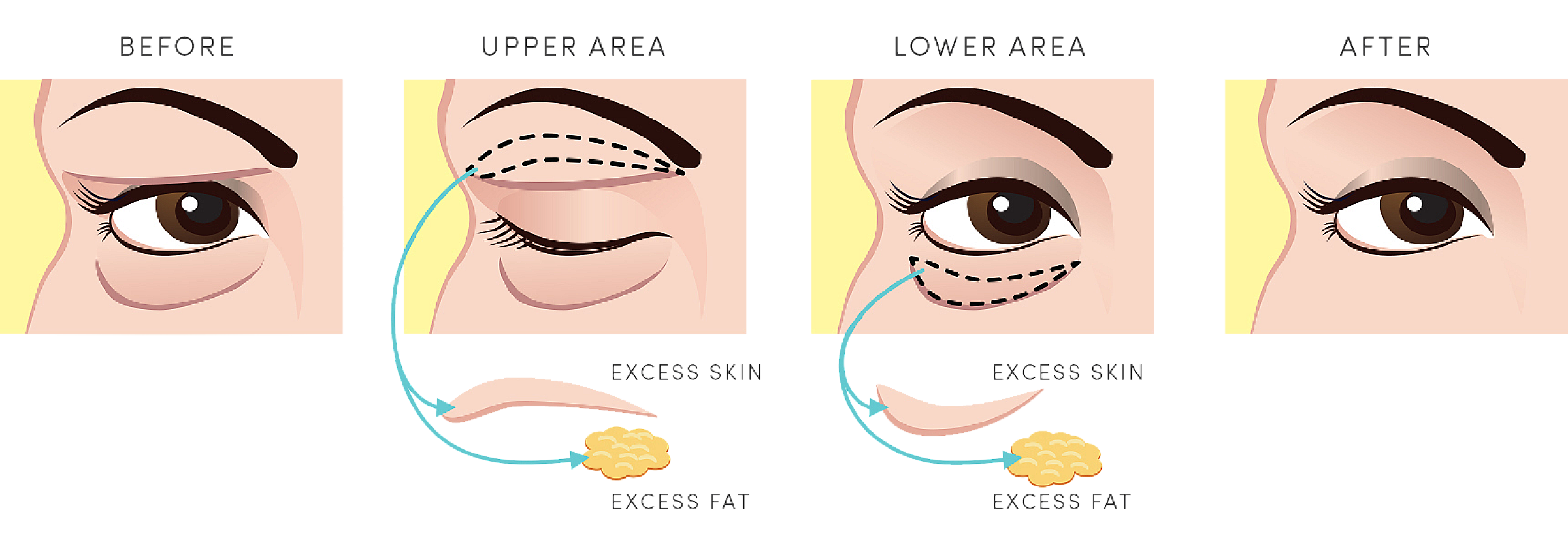 Illustration of the eyelid lift process