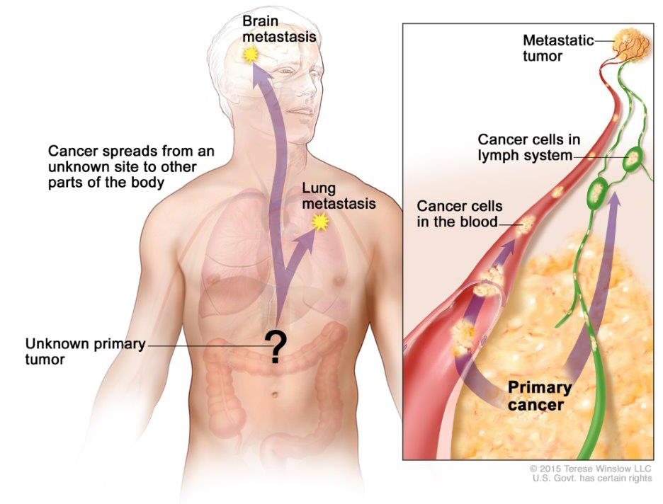 In cancers of unknown primary origin, cancer cells have spread in the body but the place where the cancer began is not known.