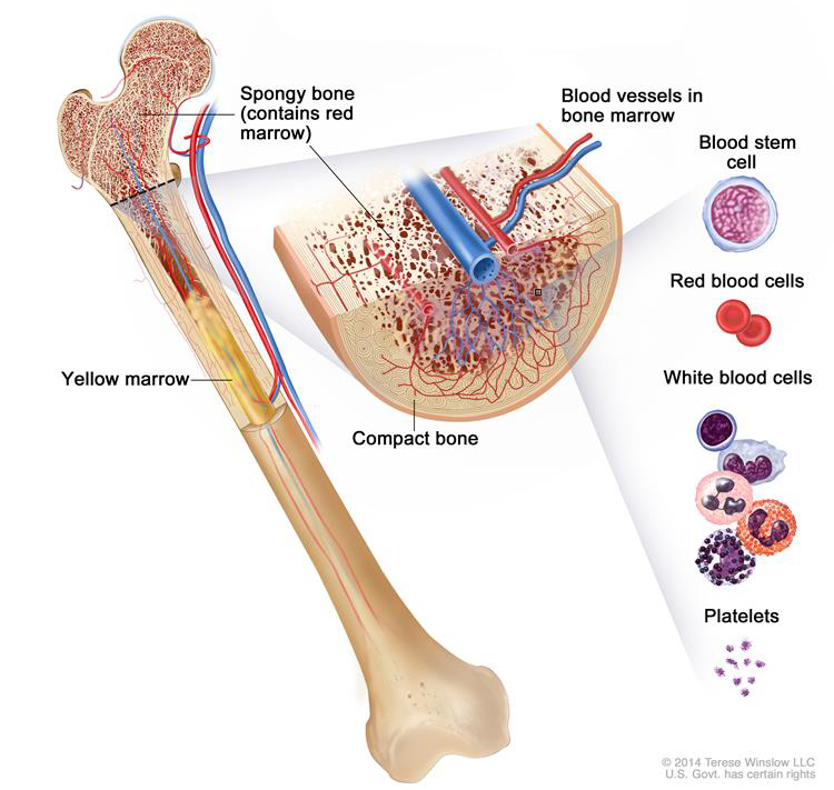 Osteosarcoma usually starts in osteoblasts, which are a type of bone cell that becomes new bone tissue. It commonly forms in the ends of the long bones of the body, which include bones of the arms and legs.