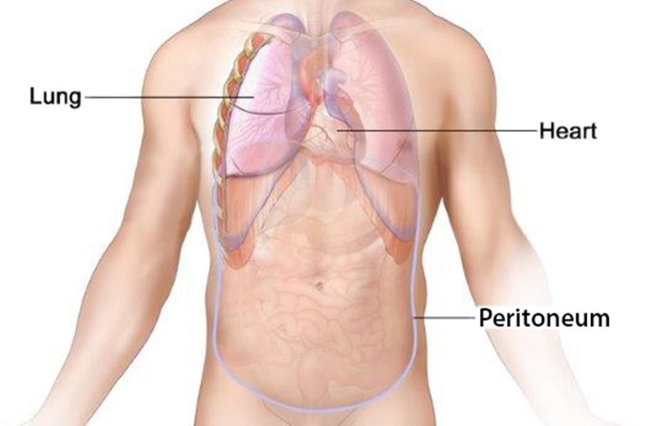 Peritoneal mesothelioma forms in the thin layer of tissue that lines the inside of the abdomen and covers the organs in the abdomen.