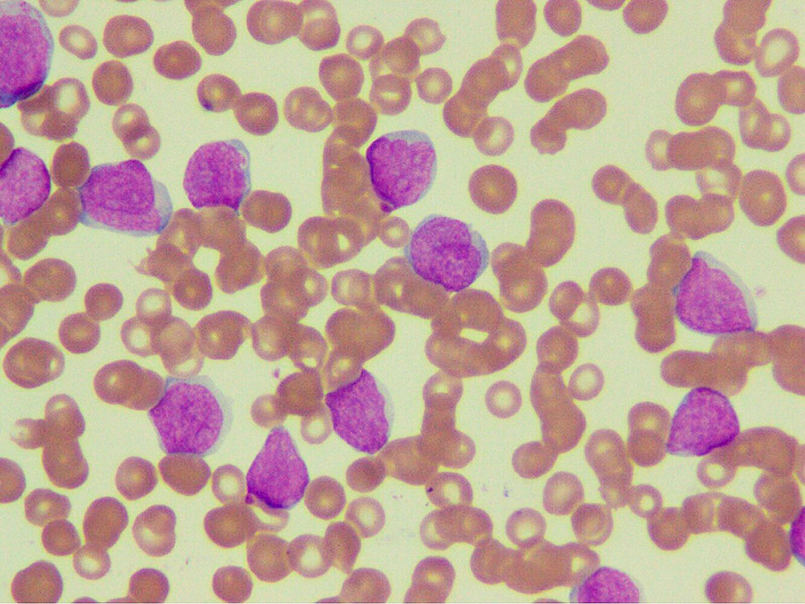 Photo of Leukemia cells