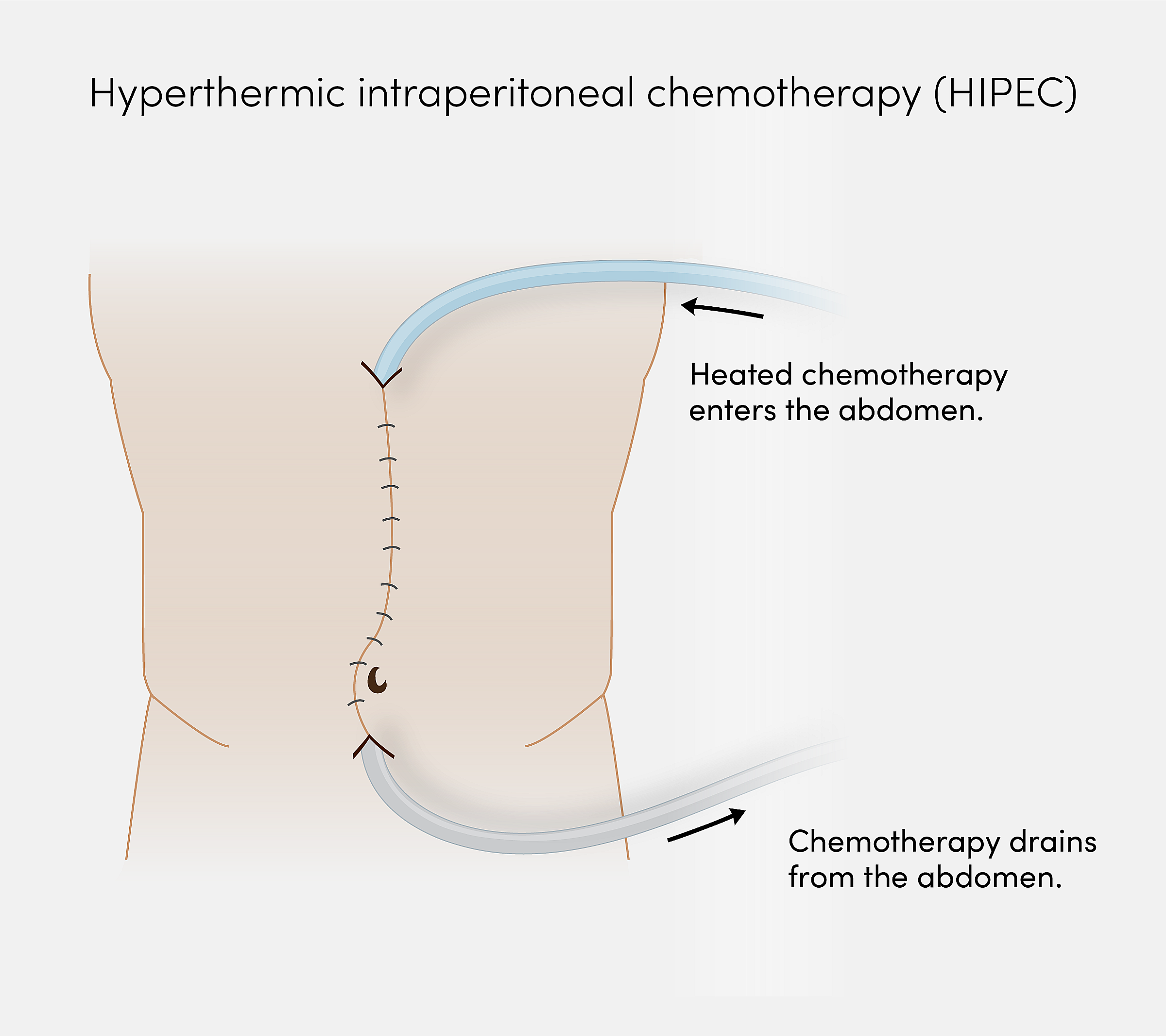 Illustration of tubes filling an abdomen with heated chemotherapy and then draining it out