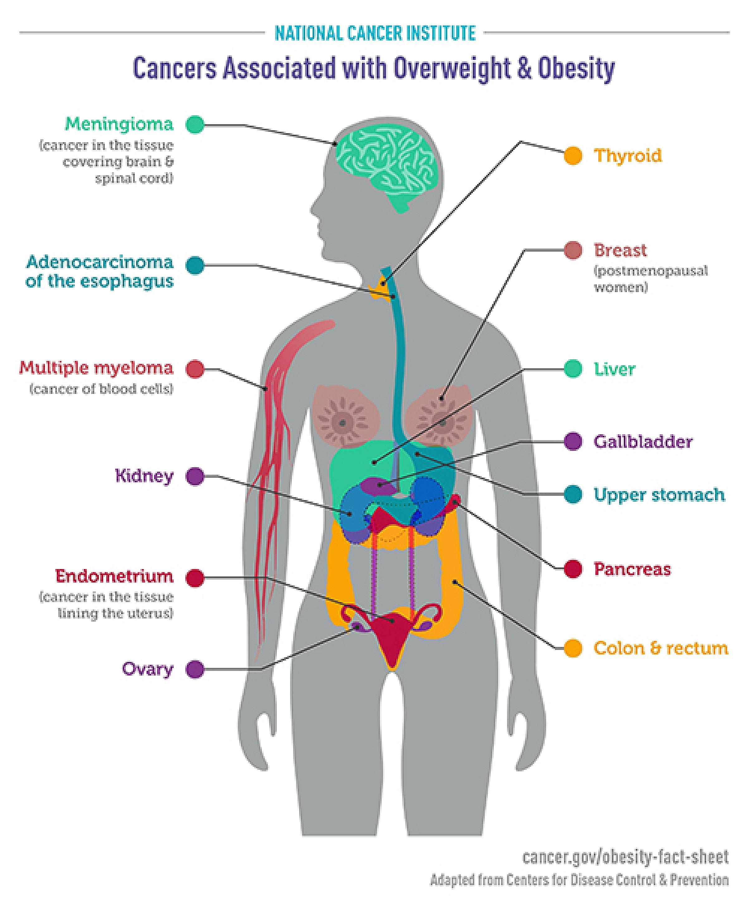 Diagram of person showing 13 types of cancers associated with obesity