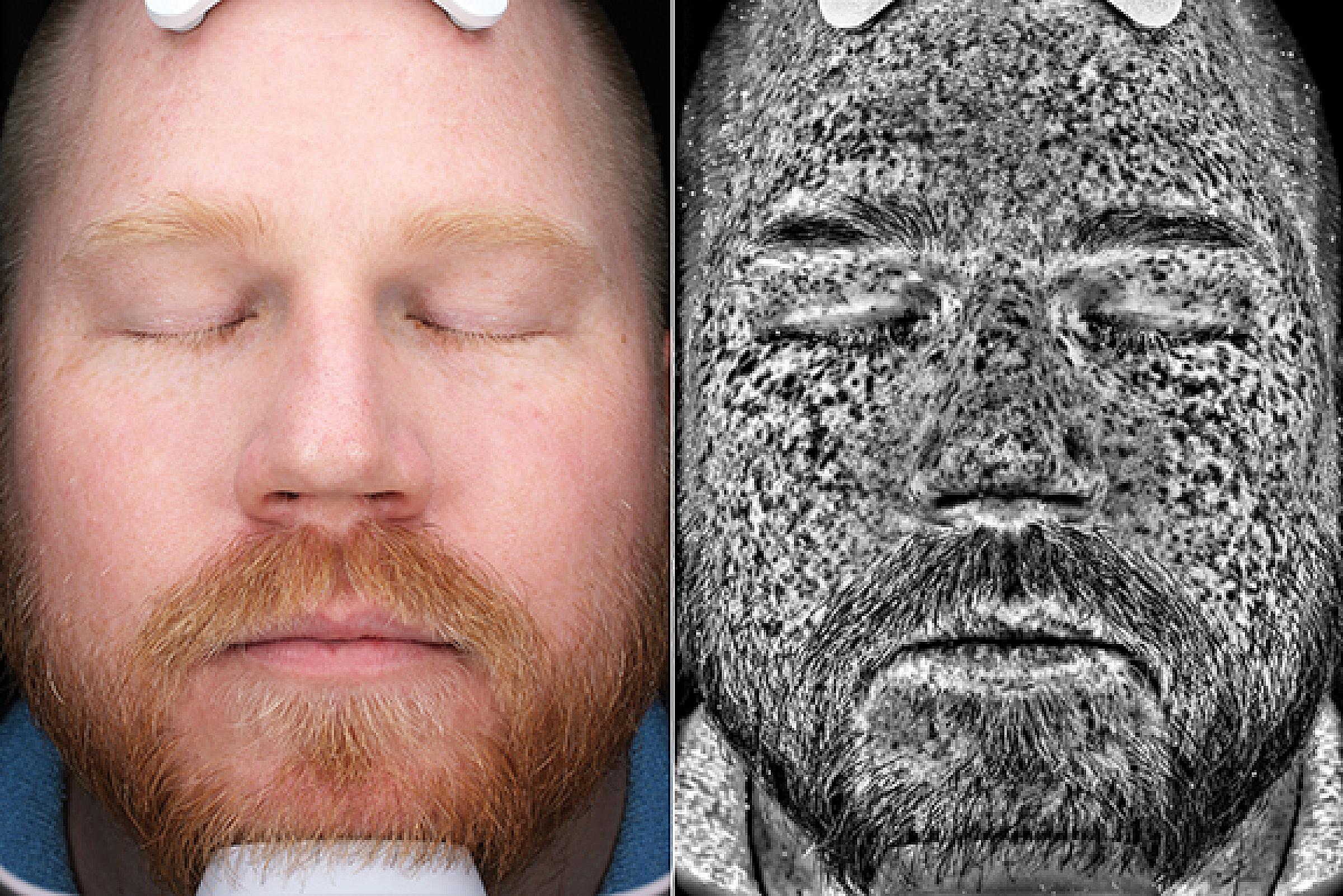 Garrett Harding facial comparison between regular and UV images