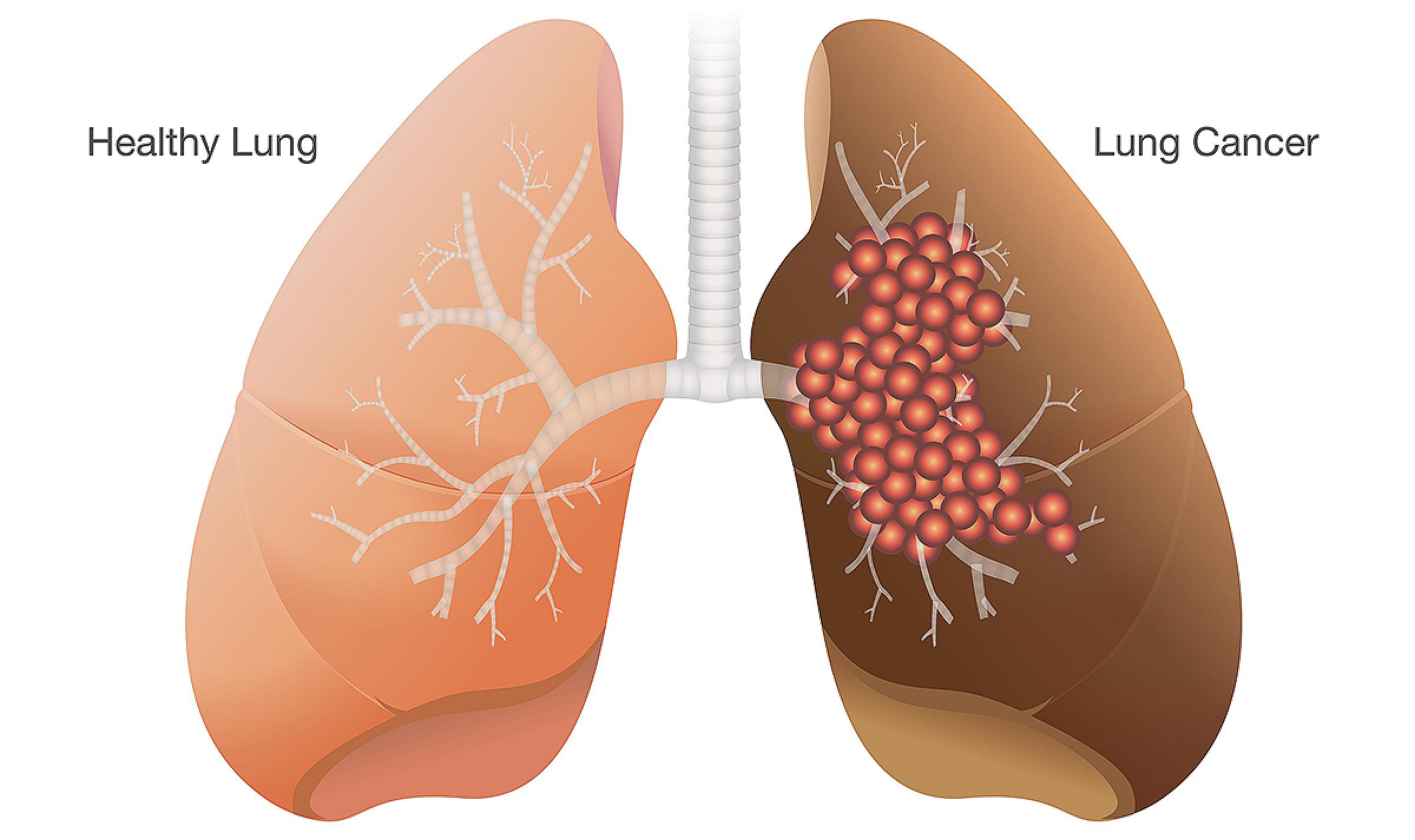 Diagram of lungs; left side is healthy, right side has cancer