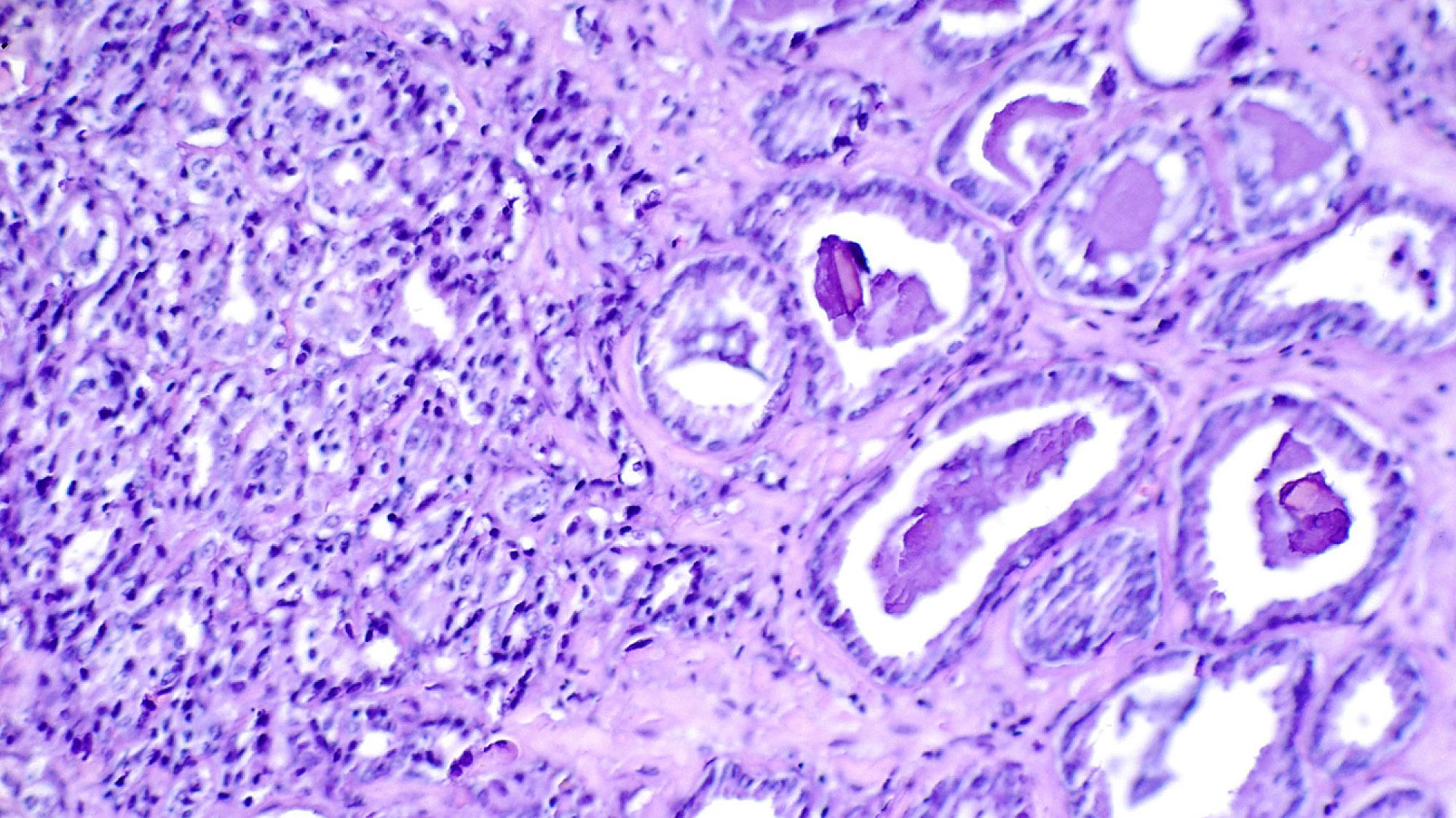 Purple colored slide of abnormal cells, indicating prostate cancer