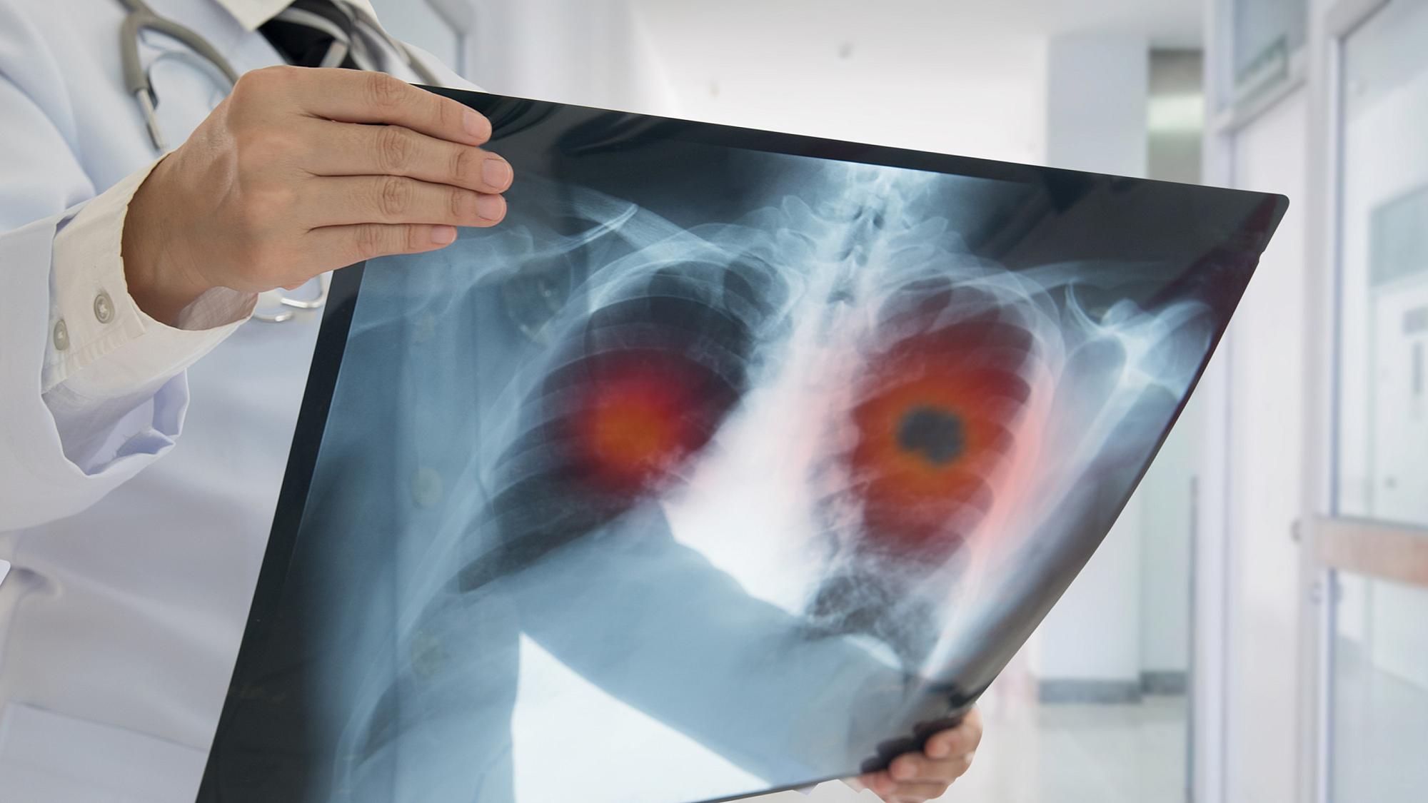 Doctor looking at x-ray of patient's lungs; part of the x-ray is highlighted in red