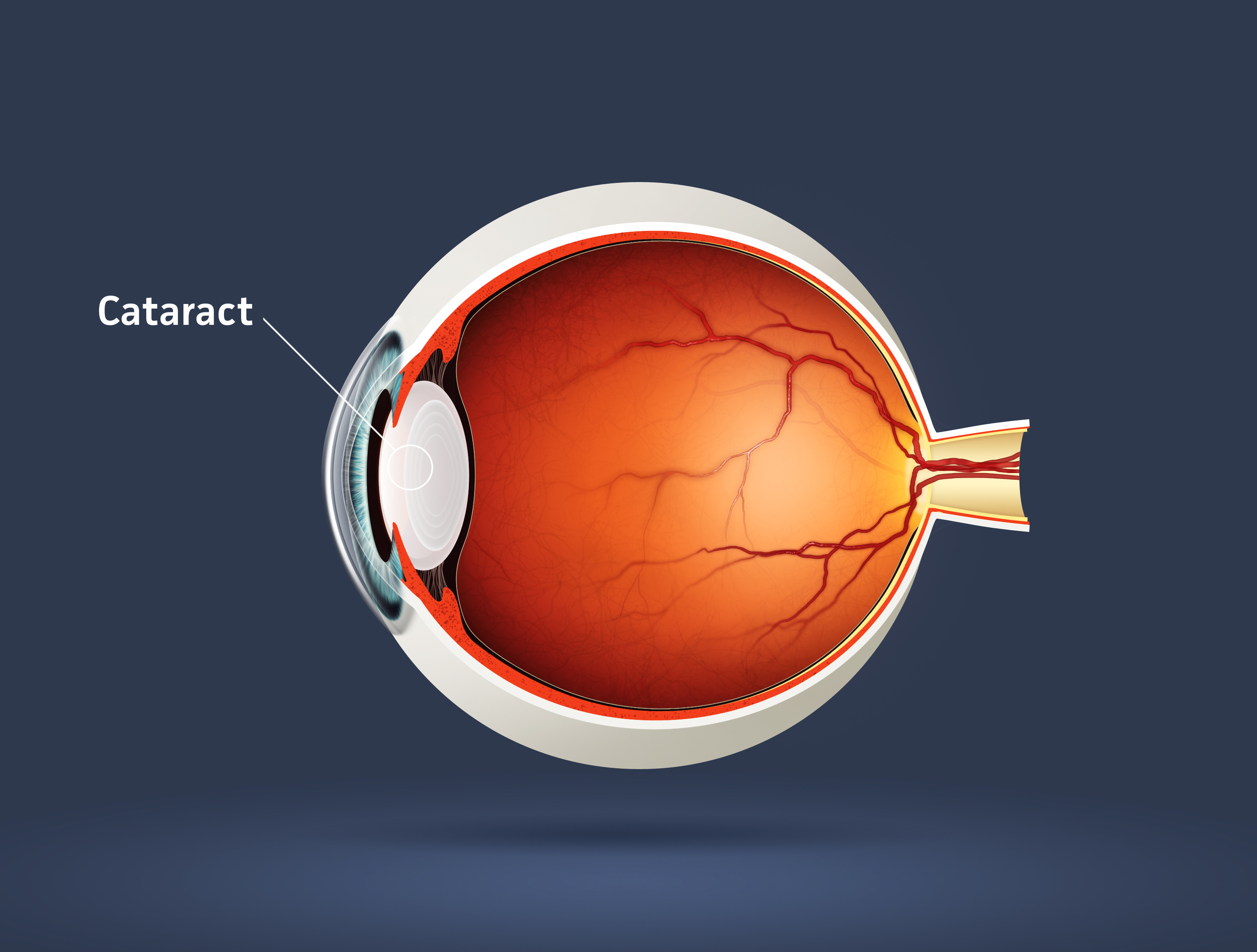 Cataract diagram