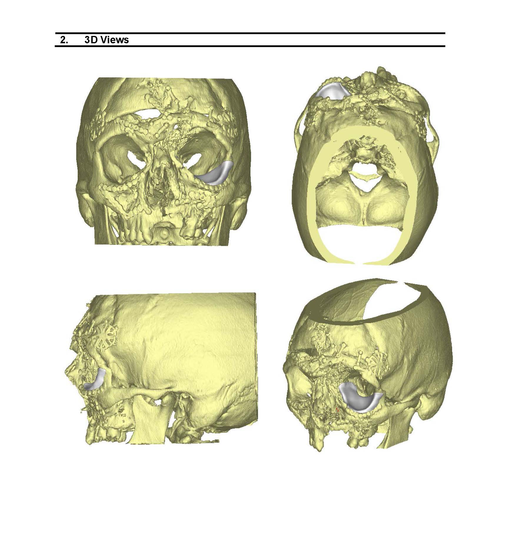3D views of designs for a customized implant based on computed tomography images of the patient's left eye socket.