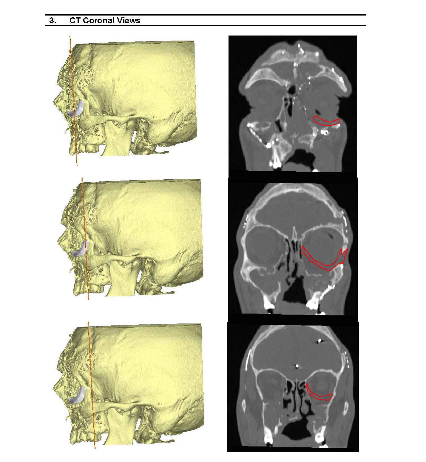 CT coronal views of designs for a customized implant based on computed tomography images of the patient's left eye socket.