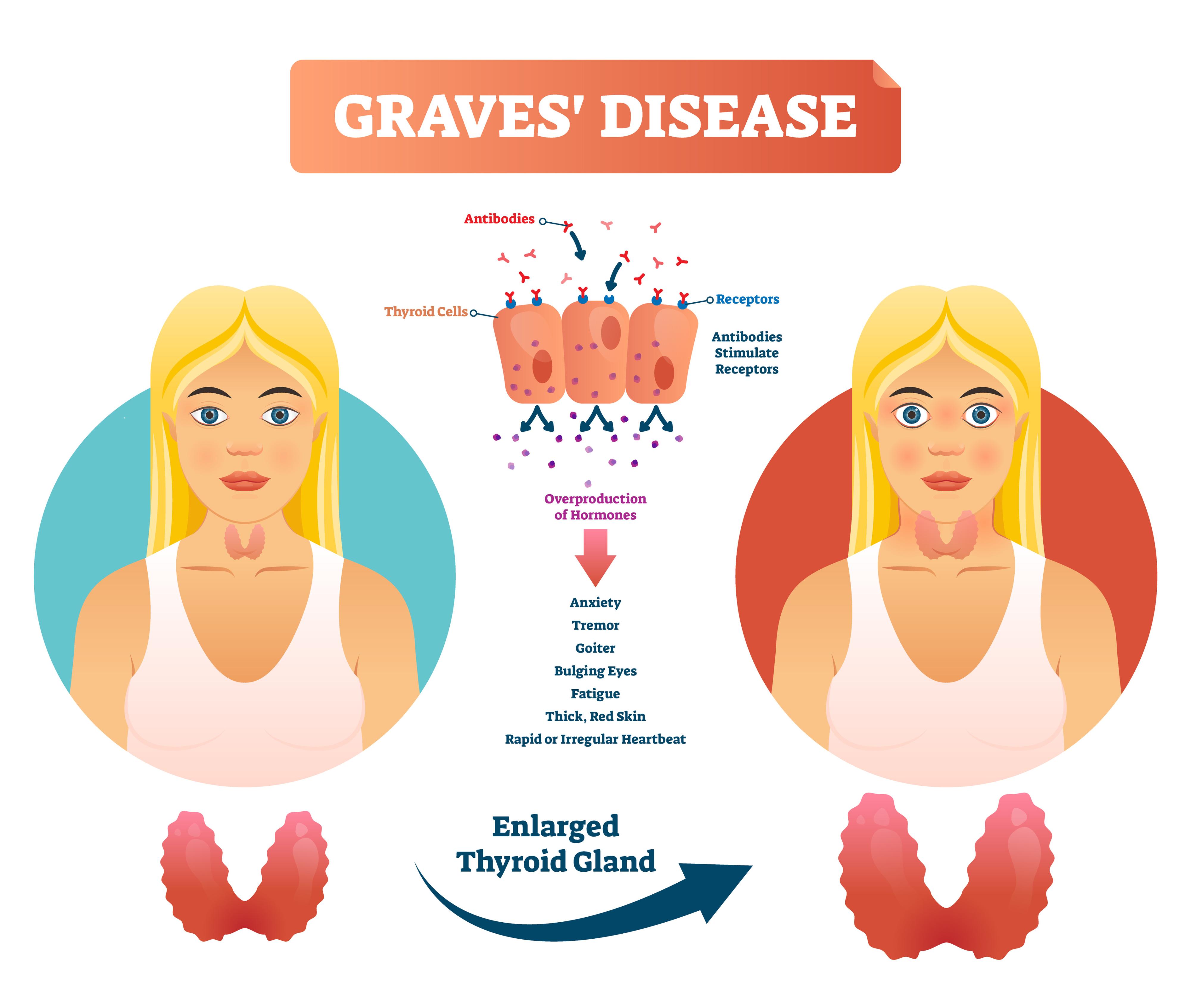 Graves' Disease Eye Symptoms