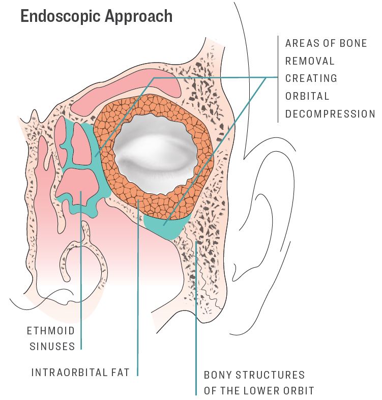 Endoscopic Approach