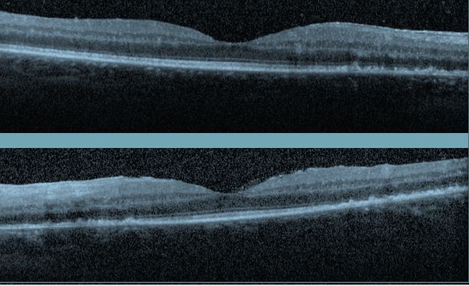 Figure 2. Macular OCT demonstrates granular disruption of the ellipsoid zone with sparing of the fovea in both eyes.
