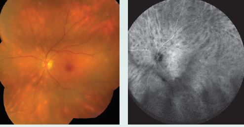 Figure 4. A color montage shows creamy yellow ovoid spots in the mid- and far-periphery, while late indocyanine green angiography demonstrates even more hypofluorescent spots.