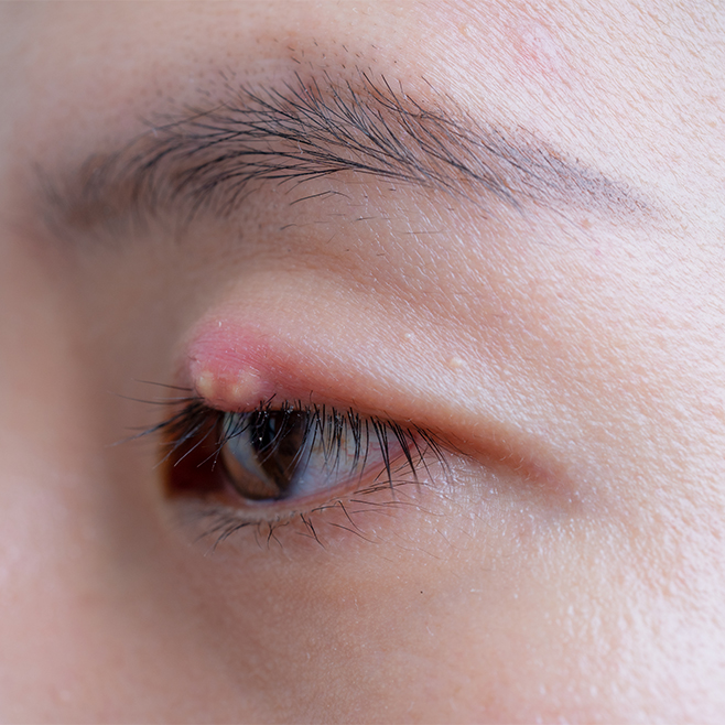 image of stye