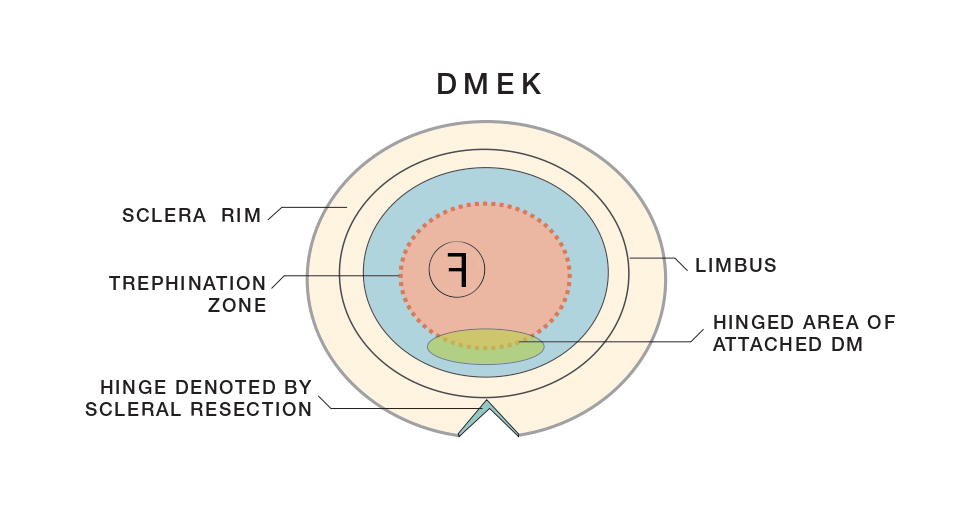 PR DMEK