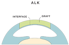 Anterior Lamellar Keratoplasty (ALK)