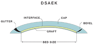 Descemet’s Stripping Endothelial Keratoplasty (DSAEK)