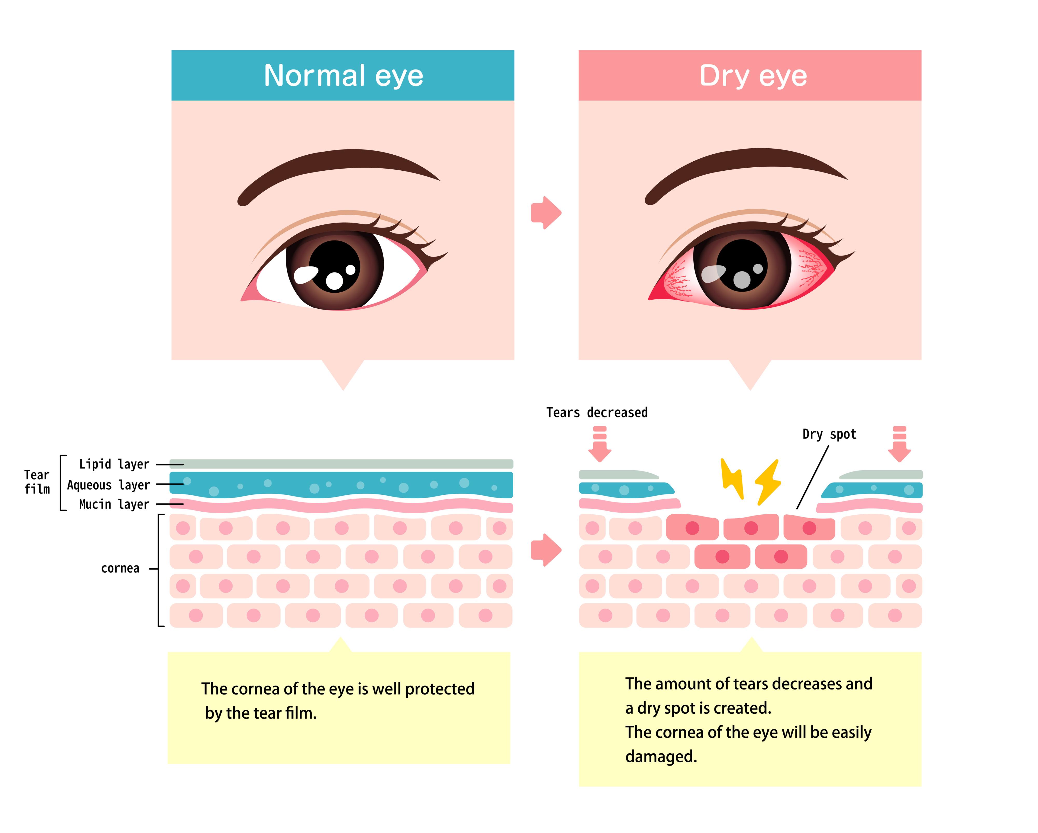 Dry Eye Graphic