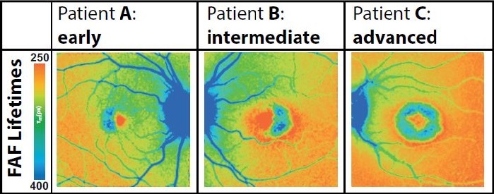 The FLIO images at left show early, intermediate, and advanced stages (blue center) of cell death in three MacTel patients.