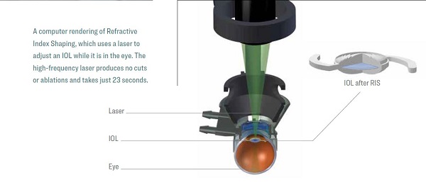 A computer rendering of Refractive Index Shaping, which uses a laser to adjust an IOL while it is in the eye. The high-frequency laser produces no cuts or ablations and takes just 23 seconds.