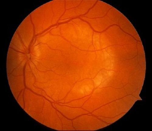 An image showing ocular syphilis, a group of inflammatory diseases in eye tissues infected by the bacteria that causes syphilis.