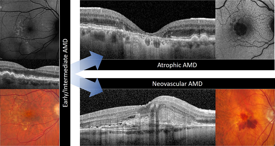 Chart showing progression of age-related macular degeneration.