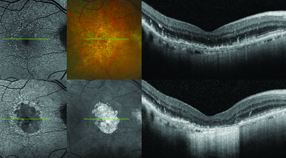 The top row of images shows changes detected in the eye of an early-stage AMD patient with mild visual symptoms. The bottom row shows the same eye four years later when advanced atrophy and tissue loss have caused a blind spot in the patient’s central vision.