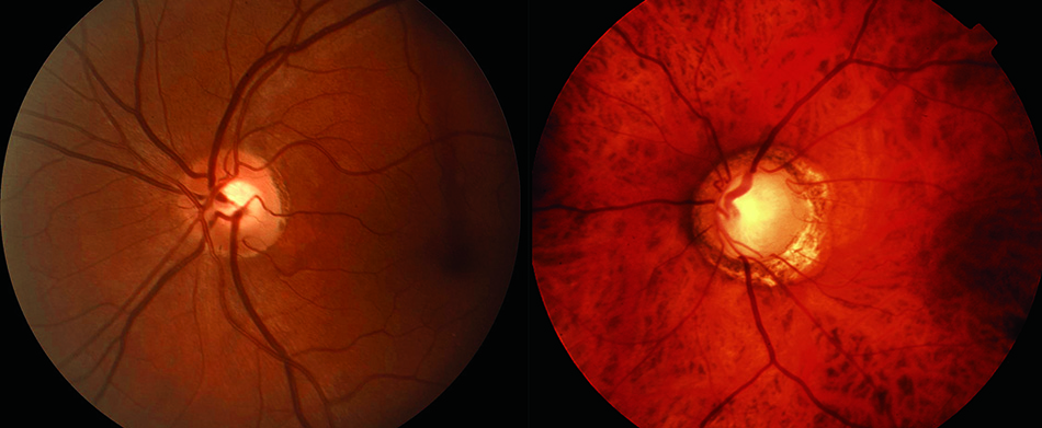 An image of a healthy optic nerve, left, and one damaged by glaucoma.