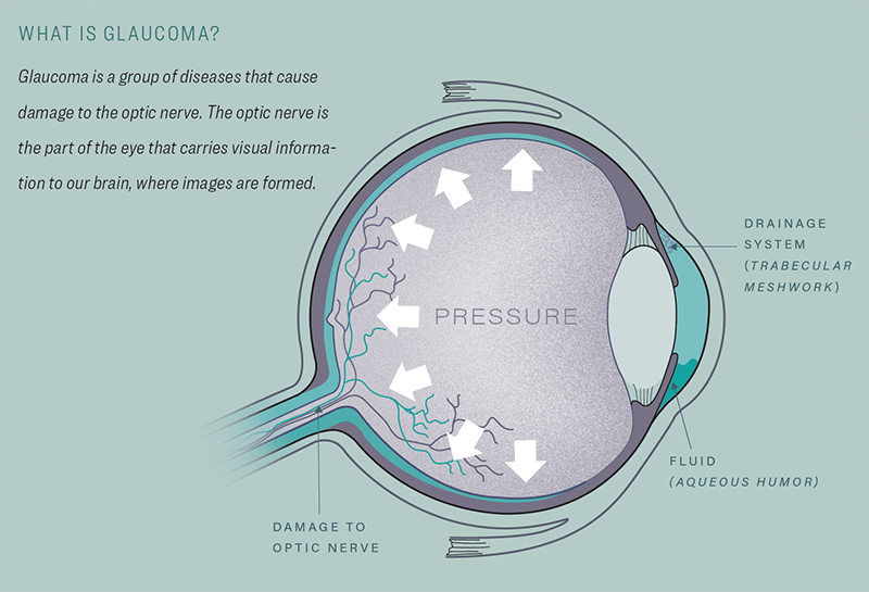 What is glaucoma graphic