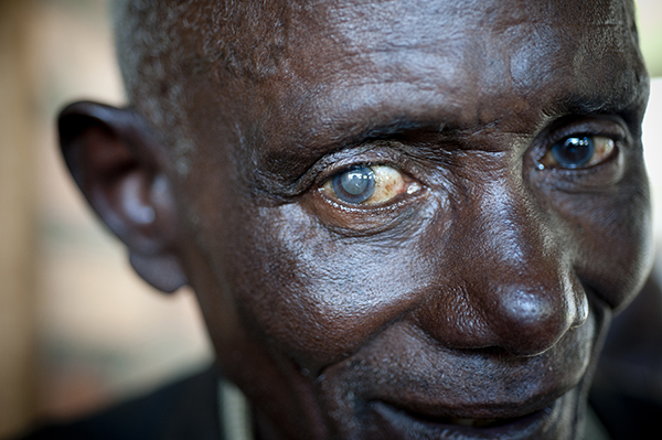 One hundred million people worldwide need cataract surgery.