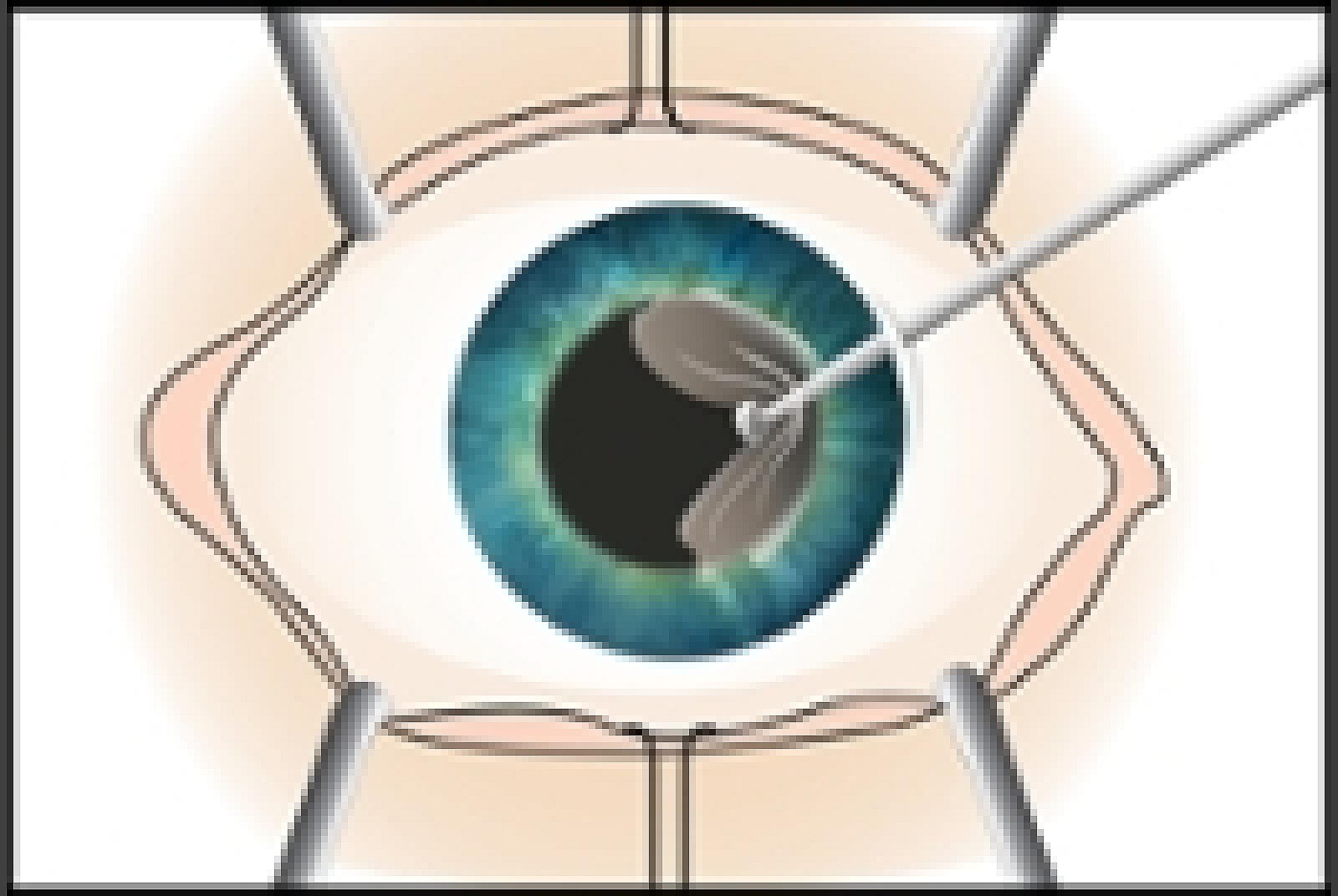 Surgeon removes the diseased/ damaged cornea