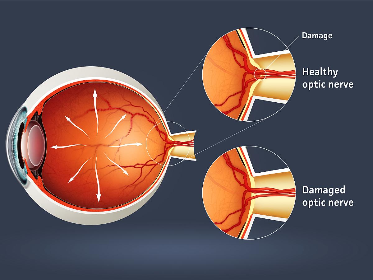 glaucoma-optic nerve diagram