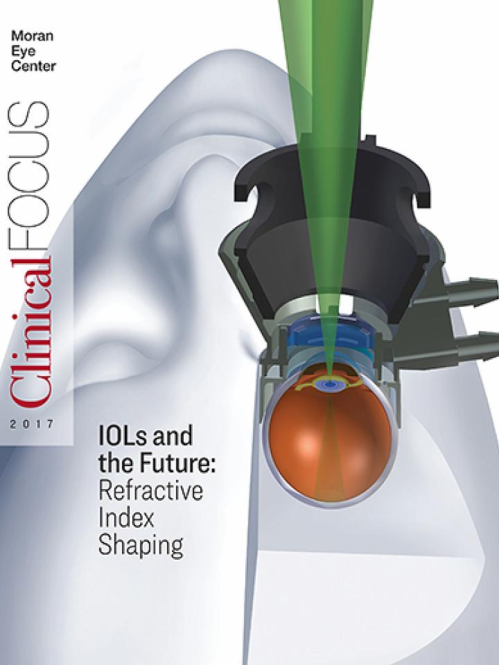 2017 Clinical Focus: IOLs and the Future: Refractive Index Shaping