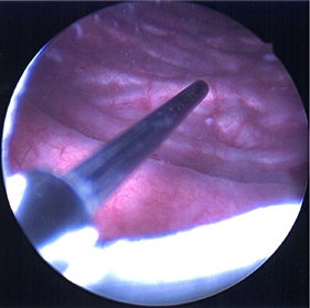 Picture of a small instrument injecting Botox into the muscle that lines the bladder wall.