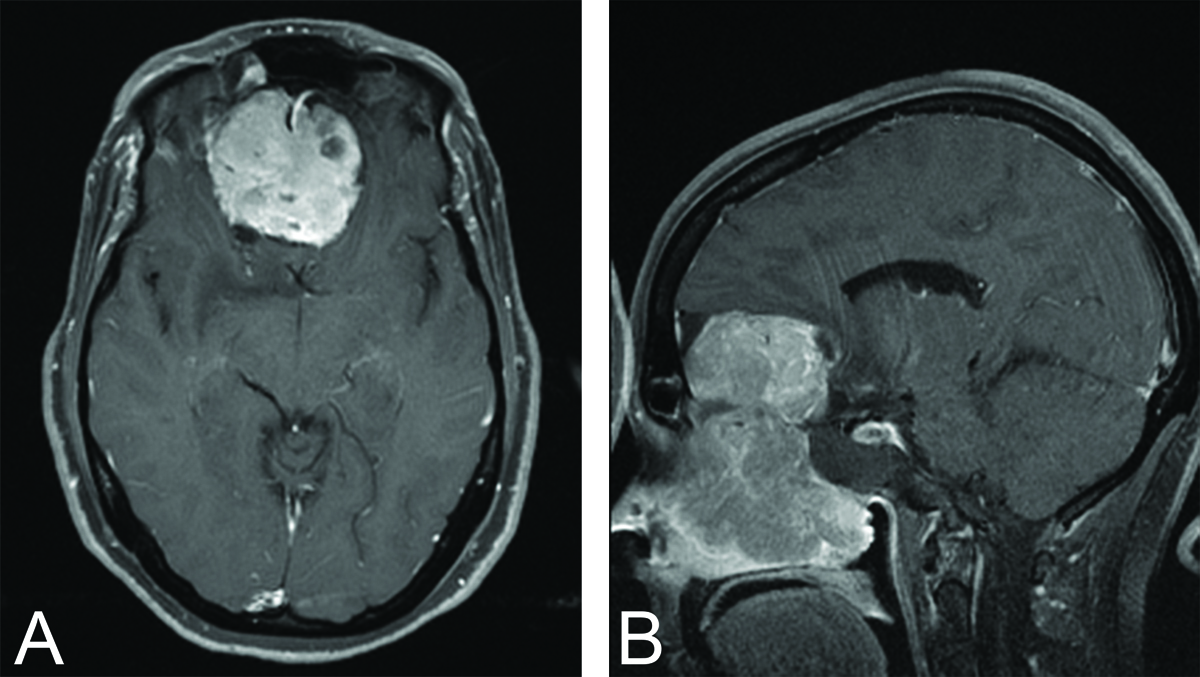 esthesioneuroblastoma-figure3.jpg