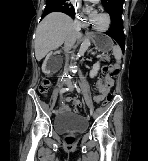 Radiology image showing an IVC filter that has penetrated the psoas muscle, a muscle in the abdomen that connects the top of the leg bone (femur) to the spine
