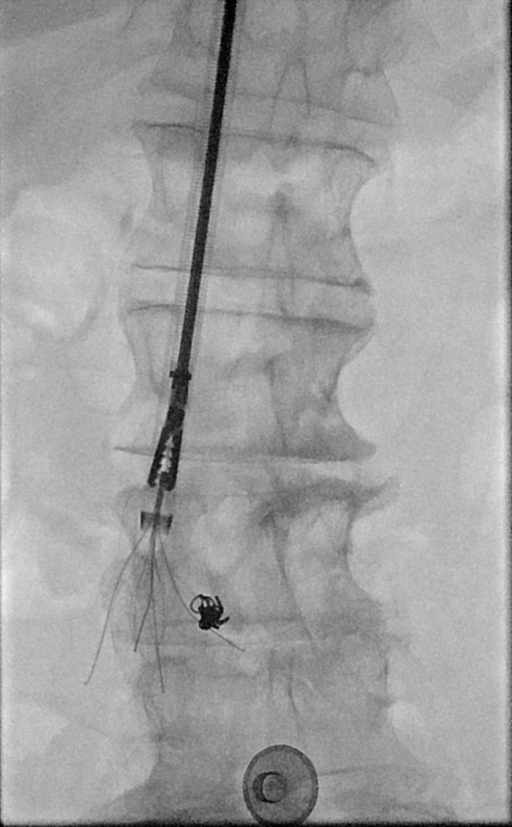 Radiology image showing a bronchial forceps, which we are using to remove a filter leg that was embedded into a spinal disc