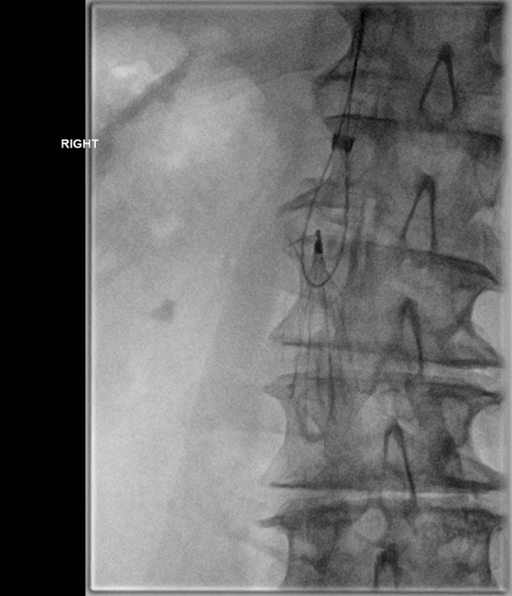 Radiology image showing the sling technique, which we use when standard techniques fail