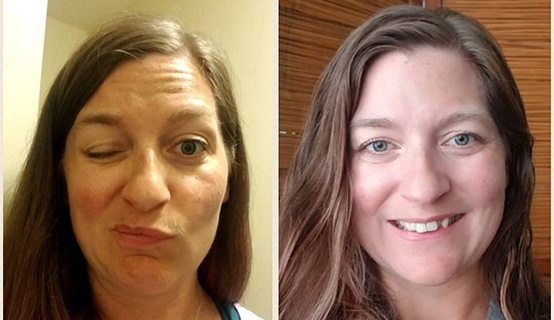 Before and after pictures of patient Amanda Rush who experienced paralysis on one side of her face before seeking treatment