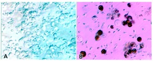 A stained semen analysis used to evaluate male infertility.