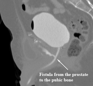 A fistula from radiation for prostate cancer, which has developed between the prostate and the pubic bone (symphysis pubis) with an infection cavity.